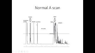 Ophthalmic Ultrasound Part 1 [upl. by Leoni396]