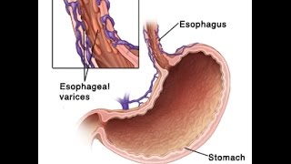 Esophageal Varices [upl. by Jessen]