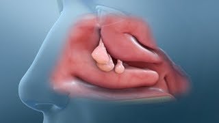 Nasal Polyp Removal Surgery [upl. by Rebmak777]