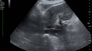 Thrombus in IVC Ultrasound JETem 2018 [upl. by Horwath306]