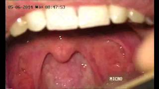 Exploración de la orofaringe  Oropharynx examination [upl. by Haroldson]