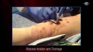 WCW Abscess Incision and Drainage [upl. by Parks547]