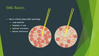 Neuropathy vs myopathy on EMG [upl. by Sapienza778]