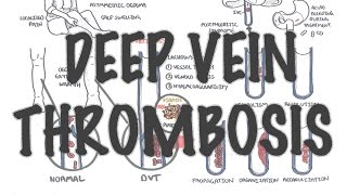 Left Ventricular Apical Thrombus [upl. by Vigen]