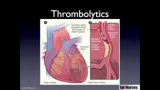 Percutaneous Coronary Interventions [upl. by Kerrison]