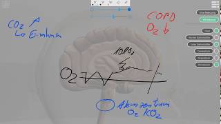 Vorsicht COPD und Sauerstoff [upl. by Manolo]