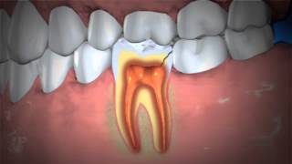 Treatment of Abscessed Teeth [upl. by Tavish154]