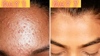 7 DAYS ALOE VERA CHALLENGE  Live Results  does it clear acnepimple amp fade scars [upl. by Conard814]