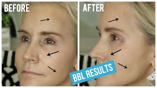 BBL LIGHT TREATMENT BEFORE AND AFTER  MY BBL LASER TREATMENT FOR BROWN SPOTS amp SPIDER VEINS [upl. by Medovich274]