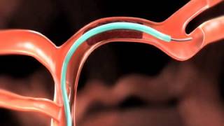 Revascularization  Regenerative Endodontic Procedure [upl. by Betty915]