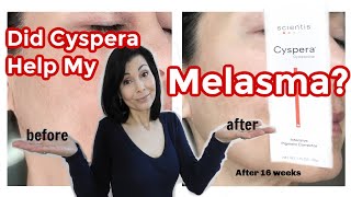 Did Cyspera® Help My Melasma My Results [upl. by Anoit]