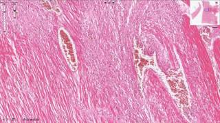 Myocardial Infarction  Histopathology [upl. by Lamarre593]