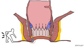 Hemorrhoids [upl. by Gilchrist]