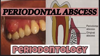 PERIODONTAL ABSCESS II PERIODONTOLOGY [upl. by Peadar]