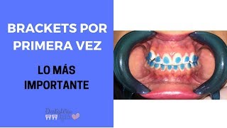 BRACKETS POR PRIMERA VEZ  Lo que debes saber de Ortodoncia [upl. by Duane]