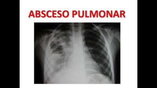 Diagnostico y tratamiento del Absceso Pulmonar MEDICINA INTERNA [upl. by Ardnuahs]