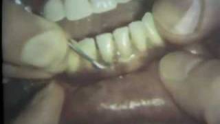 Scaling and Root Planing Part II Mandibular Teeth [upl. by Atteuqcaj897]