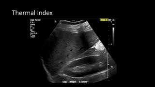 Ultrasound Physics  Image Optimization [upl. by Neirol]