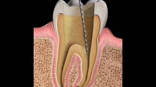 Endodontics Apexification [upl. by Enitram502]