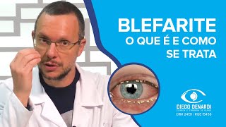 BLEFARITE A inflamação das pálpebras  Dr Diego Denardi  2020 [upl. by Abba]