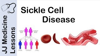 Sickle Cell Disease  Pathophysiology Symptoms and Treatment [upl. by Elagiba413]