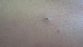 Dilated Pore Treatment [upl. by Balmuth]