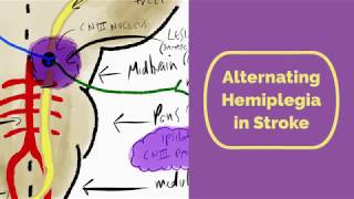 Alternating Hemiplegia in Stroke [upl. by Sinoda929]