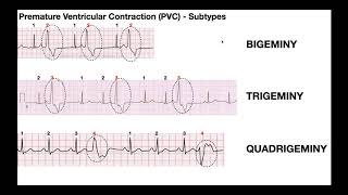 EKG Patterns  Premature Atrial amp Ventricular Contractions PACs amp PVCs [upl. by Iman]