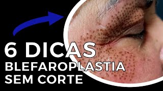 Como fazer a Blefaroplastia sem Corte  6 DICAS [upl. by Northrup650]