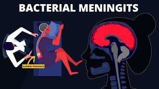 Bacterial Meningitis  Symptoms Diagnosis Treatments amp Pathology [upl. by Lleddaw883]