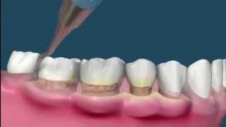 Raspado y alisado radicular  Periodoncia [upl. by Lucinda345]