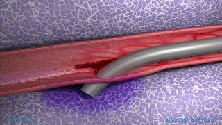 Peripheral IV Infiltration Animation [upl. by Nodyarb269]