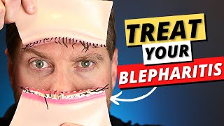 Blepharitis Top 3 Treatments For Blepharitis Removal At Home [upl. by Findley]