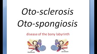 OTOSCLEROSIS  Causes  Pathophysiology  Diagnosis  Nursing Management  The Nurses Station [upl. by Baiss424]