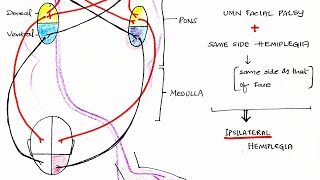 Hemiplegia CVA  Stroke  Theory amp Clinical discussion [upl. by Goddord674]