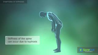 Kyphosis Symptoms [upl. by Paza]