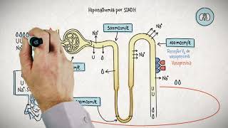 HIPONATREMIA Y SU TRATAMIENTO [upl. by Rialcnis]