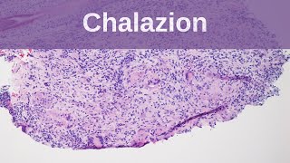 Chalazion  Pathology mini tutorials [upl. by Nowd880]