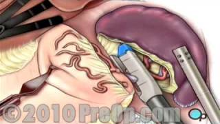 Spleen Removal Laparoscopic PreOp® Patient Education [upl. by Nastassia]