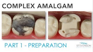 Complex Amalgam Preparation  Part 1 [upl. by Aprile865]