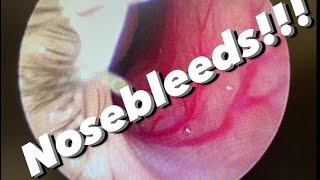 Nosebleeds epistaxis causes prevention treatments and more [upl. by Shurlocke102]