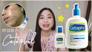 CETAPHIL Gentle Skin Cleanser Review  Maganda ba sa acne prone skin 🤔 [upl. by Atronna]