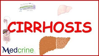 Cirrhosis Of Liver Life Expectancy By Stage [upl. by Assyla893]