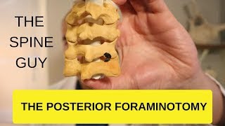 CERVICAL STENOSIS RADICULOPATHY  PART 4  THE POSTERIOR FORAMINOTOMY [upl. by Osicran]