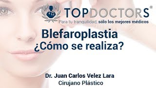 Blefaroplastia ¿Cómo se realiza el levantamiento de párpados [upl. by Rodge575]