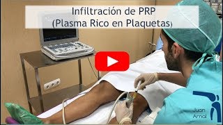 Infiltración Plasma Rico en Plaquetas PRP en TENDÓN ROTULIANO [upl. by Siugram]