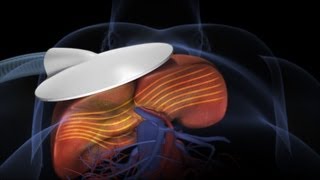 What is Otosclerosis [upl. by Cull]