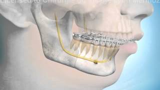 Chirurgie orthognatique ostéotomie mandibulaire [upl. by Terrijo]