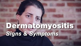 Dermatomyositis – Signs amp Symptoms  Johns Hopkins [upl. by Colley]