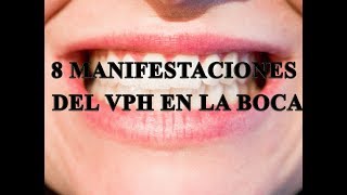 8 manifestaciones de VPH en la boca [upl. by Sedinoel]